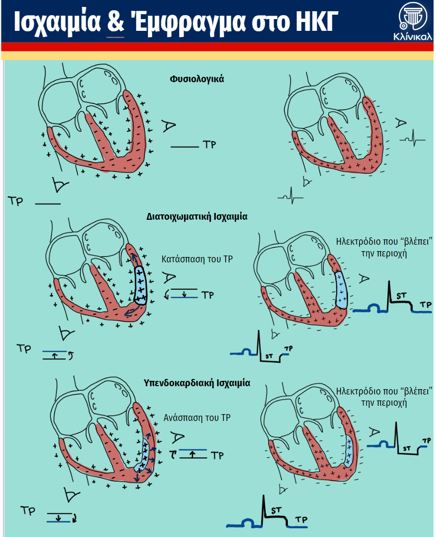 Read more about the article Ισχαιμία & Έμφραγμα στο ΗΚΓ